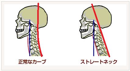 ストレートネック