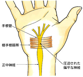 carpal_tunnel_syndrome_02