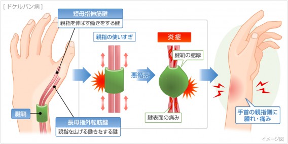 腱鞘炎