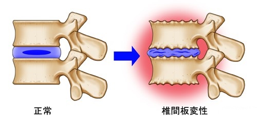 腰椎椎間板症