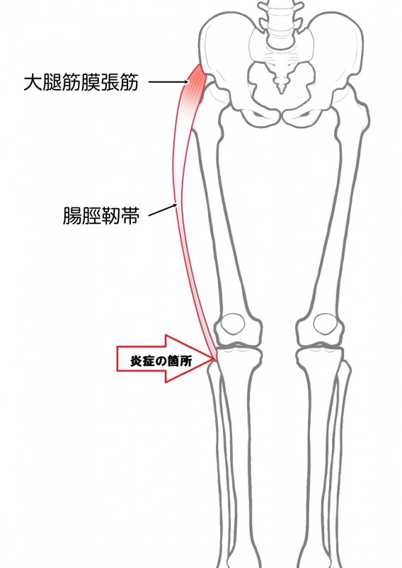 腸脛靭帯（ランナー膝）３