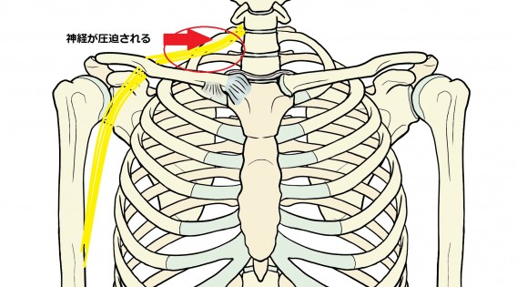 胸郭出口症候群2