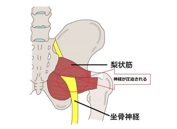 梨状筋症候群3